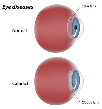 Cataract in Regulus