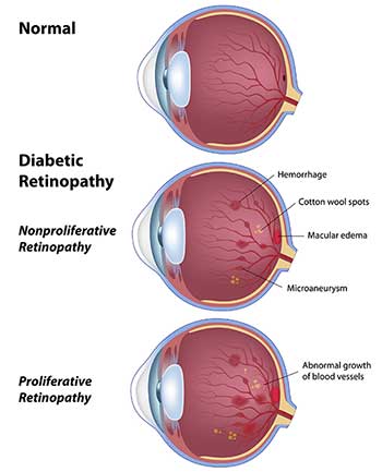 Diabetic Retinopathy in Regulus