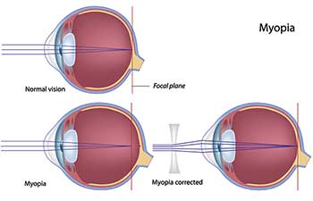 Regulus Nearsightedness