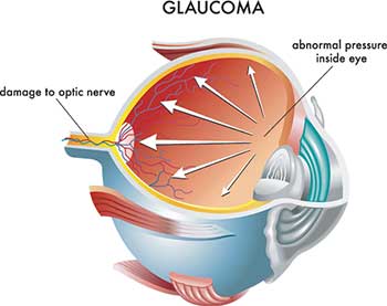 Glaucoma in Regulus