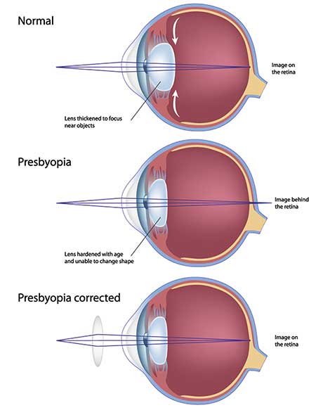 Presbyopia in Regulus